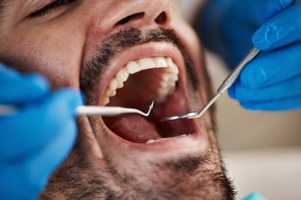 Best Broken or Chipped Tooth Repair in Remerton, GA